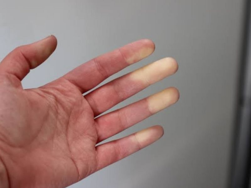 Tratamento para Esclerose sistemica Esclerodermia em Curitiba 1