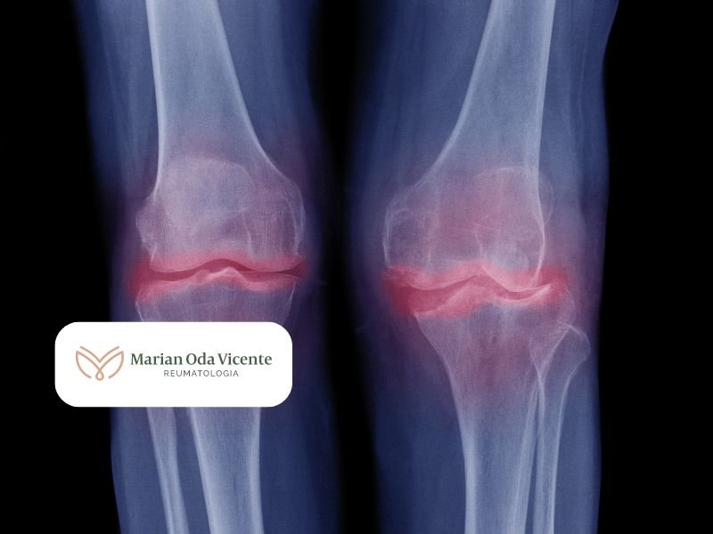 Tratamento para Osteoartrite Artrose em Curitiba