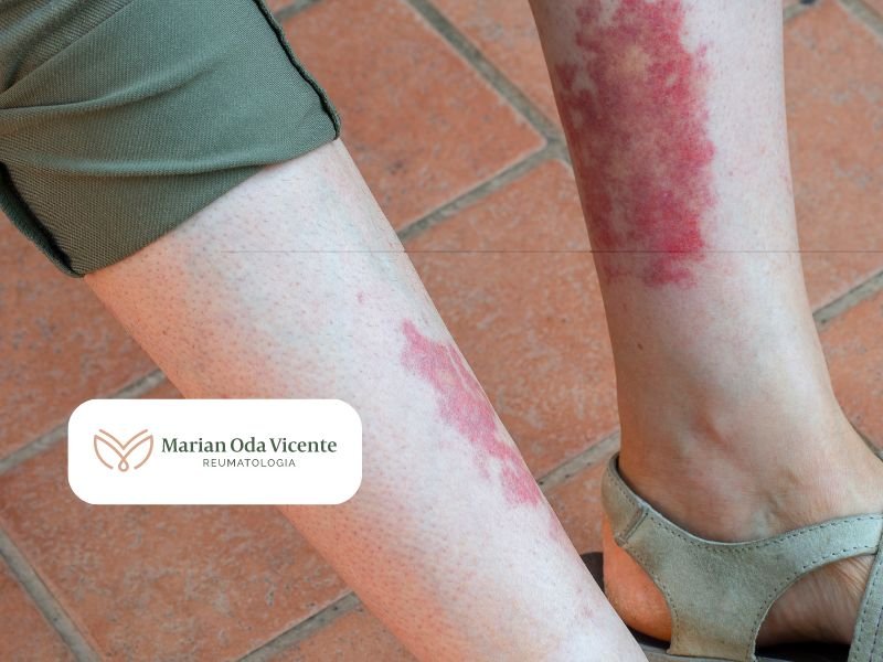 Tratamento para Vasculites em Curitiba